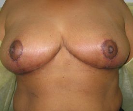 Manhattan Breast Reduction After